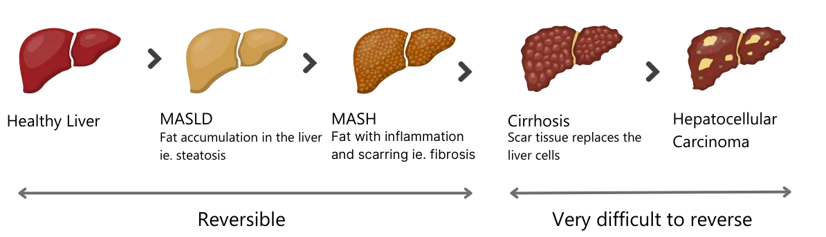 Progresión de Enfermedad Hepática